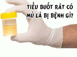 Đi tiểu buốt ra mủ trắng có phải bị bệnh lậu?