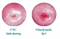 Tác hại viêm lộ tuyến cấp độ 1 như thế nào?