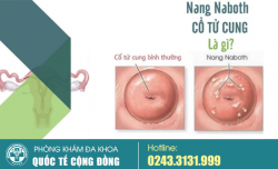 Nang naboth cổ tử cung, chớ coi thường