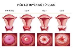 Tác hại viêm lộ tuyến cổ tử cung: Không thể xem thường!