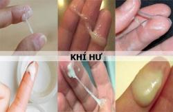 Nhận biết khí hư ra nhiều: Dấu hiệu cảnh báo bệnh gì?