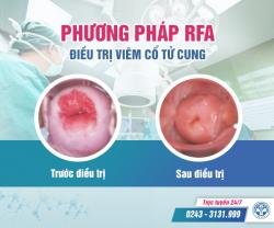 Đốt viêm cổ tử cung có an toàn không?