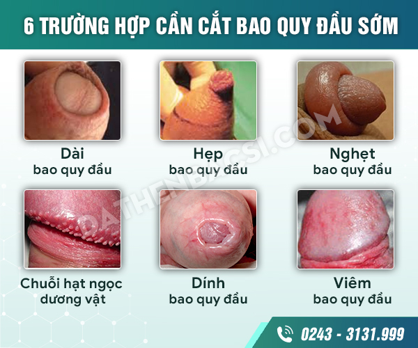 Dài, hẹp bao quy đầu có nên cắt không? : Đặt hẹn trực tuyến – Đặt ...