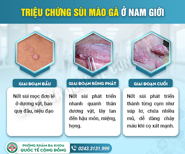 Sùi mào gà dai dẳng vì tự ý dùng thuốc chữa tại nhà