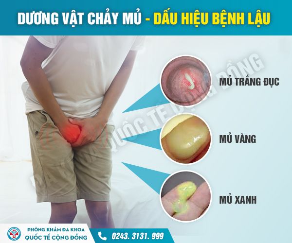 Chuyên gia giải đáp: Chảy mủ ở bộ phận sinh dục có nguy hiểm không?