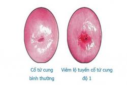 Viêm lộ tuyến cổ tử cung độ 1: Nguyên nhân, triệu chứng, cách chữa kịp thời