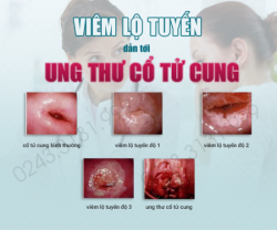 Dấu hiệu, triệu chứng viêm lộ tuyến cổ tử cung các cấp độ